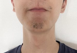ヒゲ脱毛　10回目　経過
